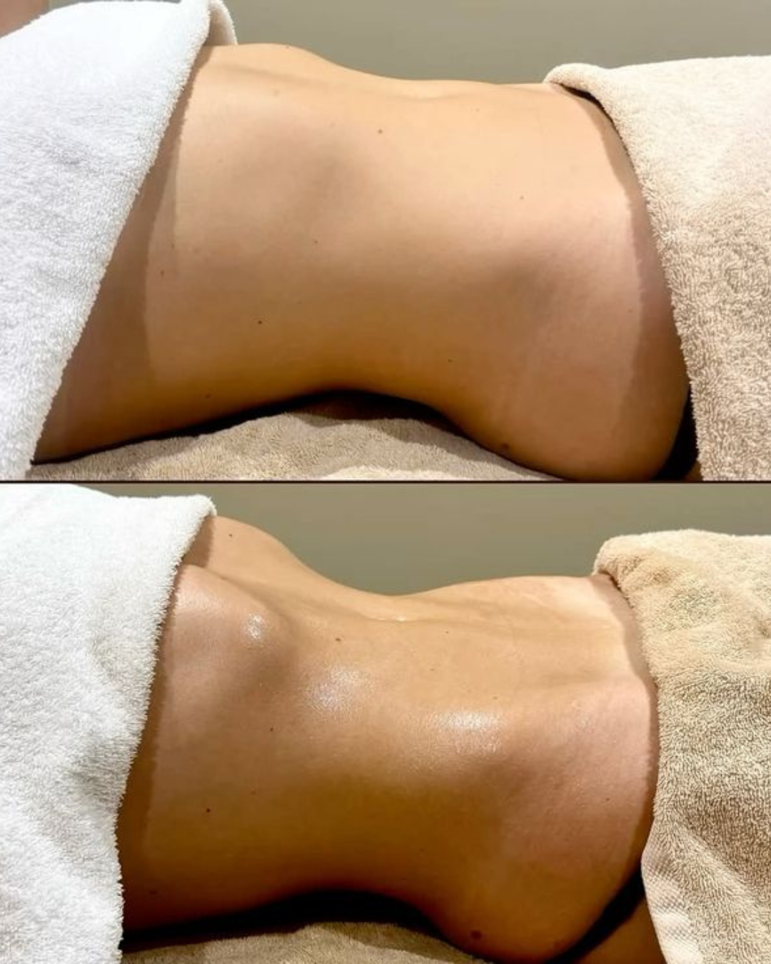 Massagem modeladora antes depois